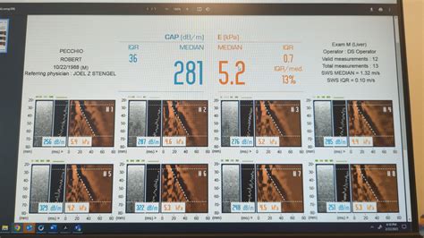 bad fibroscan results|An expert's guide to Fibroscan .